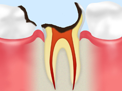 【C4】歯根のむし歯