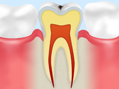 【CO】ごく初期のむし歯