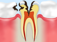【C3】神経のむし歯