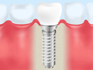 インプラント治療