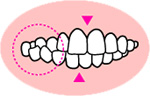 交叉咬合こうさこうごう