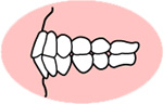 上下顎前突じょうげがくぜんとつ