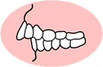 上顎前突じょうがくぜんとつ