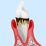【レベル4】重度歯周炎