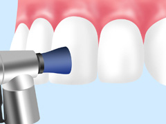 歯のクリーニング