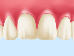 歯のホワイトニング